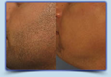 Men's Beard laser hair removal treatment