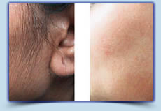 Sideburns laser hair removal treatment